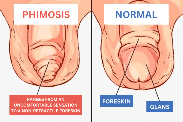 Phimosis Treatment To Relieve Tight Foreskin Pain In Ireland Phimosis Treatment To Relieve Tight Foreskin Pain In Ireland